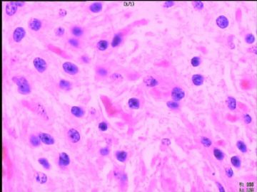 室管膜瘤与毛细胞星型细胞瘤可合并存在吗？图14