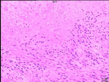 室管膜瘤与毛细胞星型细胞瘤可合并存在吗？图18