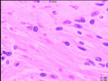 室管膜瘤与毛细胞星型细胞瘤可合并存在吗？图19