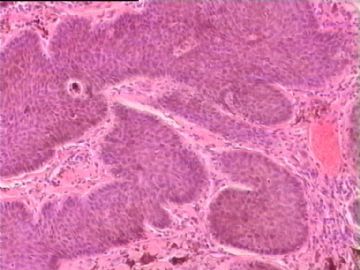 是基底细胞乳头状瘤，还是基底细胞癌？图3