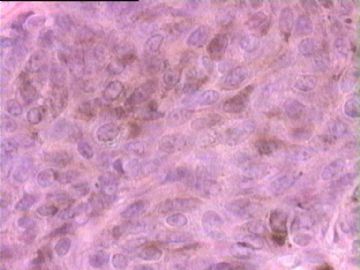 是基底细胞乳头状瘤，还是基底细胞癌？图9