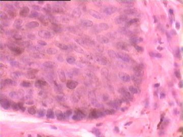 是基底细胞乳头状瘤，还是基底细胞癌？图10