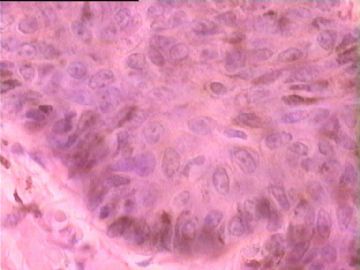 是基底细胞乳头状瘤，还是基底细胞癌？图11