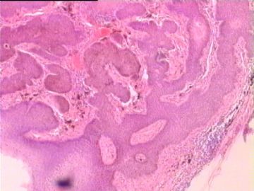 是基底细胞乳头状瘤，还是基底细胞癌？图12