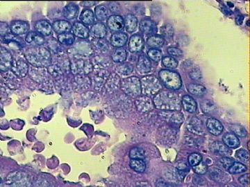 宫颈炎症，哪一类型的呢？急！！有大量浆细胞和中性粒细胞。图5