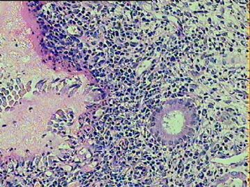 宫颈炎症，哪一类型的呢？急！！有大量浆细胞和中性粒细胞。图8