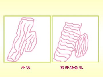 横结肠肿瘤（新加免疫组化）图1