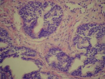 前列腺基底细胞增生？图14
