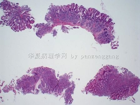 Gastric lesion图1