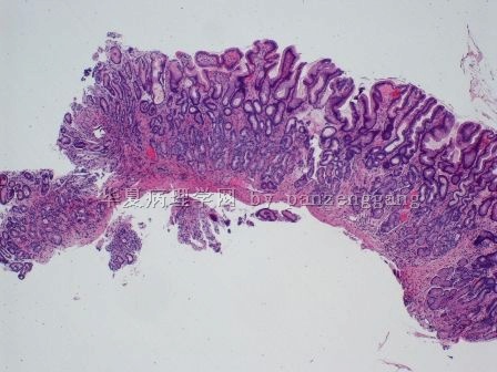 Gastric lesion图2