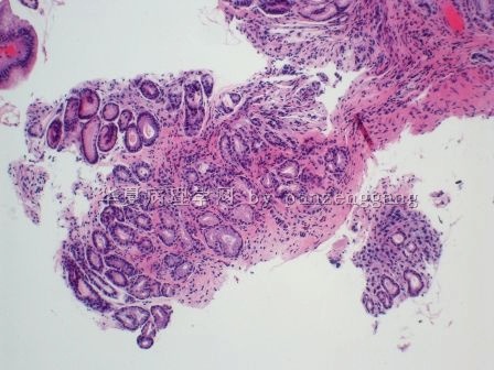 Gastric lesion图3