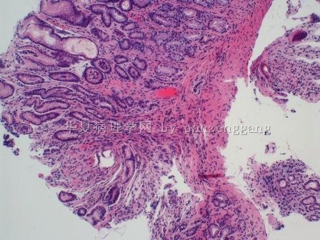 Gastric lesion图4