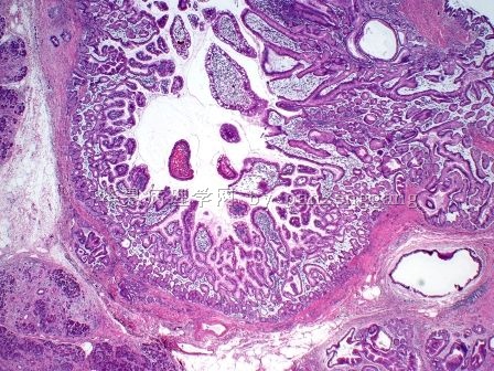 Pancreatic lesion图1