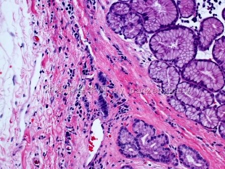 Pancreatic lesion图5