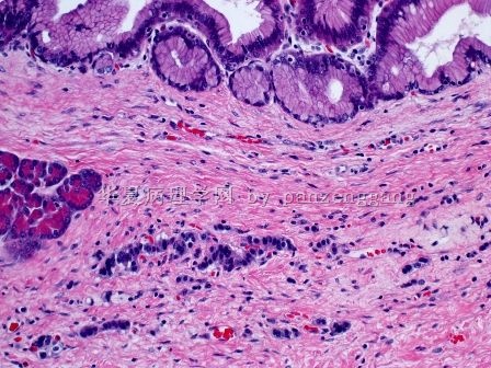 Pancreatic lesion图8