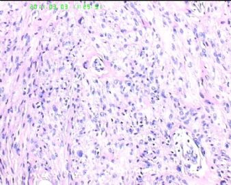 78岁女性子宫肌瘤，片中深染的是什么细胞？图2