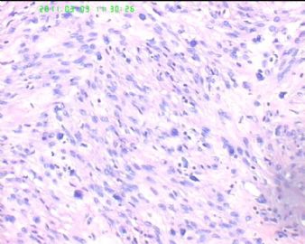 78岁女性子宫肌瘤，片中深染的是什么细胞？图3