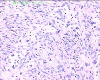 78岁女性子宫肌瘤，片中深染的是什么细胞？图7