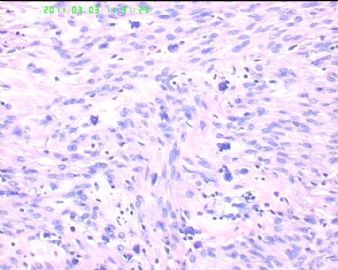 78岁女性子宫肌瘤，片中深染的是什么细胞？图8