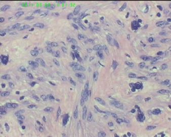78岁女性子宫肌瘤，片中深染的是什么细胞？图9