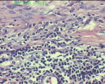 78岁女性子宫肌瘤，片中深染的是什么细胞？图10