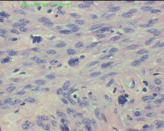 78岁女性子宫肌瘤，片中深染的是什么细胞？图18