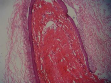 腹膜包裹肿物图3