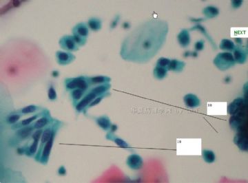 白带异常宫颈液基 (2011-3-2) ---的具体理解,请指正,谢谢.图7