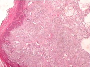 右颞顶部肿块：透明细胞汗腺瘤？？？图8