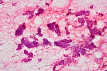 （已公布）山东省细胞病理学会议病例-2图2