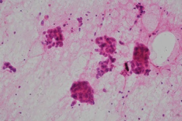 （已公布）山东省细胞病理学会议病例-2图4