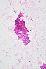 （已公布）山东省细胞病理学会议病例-3图2