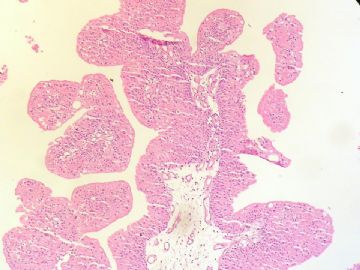 经典病例学习-尿路上皮乳头状瘤图5
