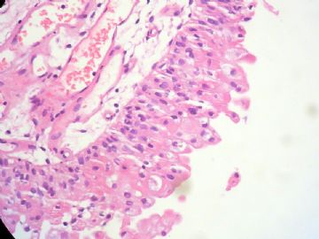 经典病例学习-尿路上皮乳头状瘤图10