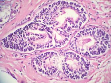 前列腺电切组织图9