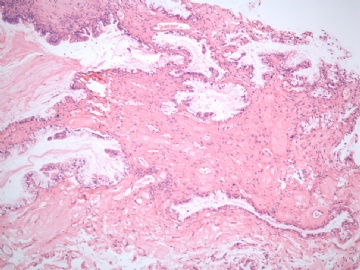 已确诊-左卵巢交界性内膜样囊性腺纤维瘤图1