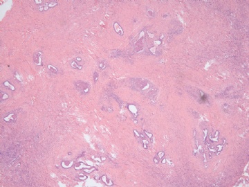 已确诊-左卵巢交界性内膜样囊性腺纤维瘤图2