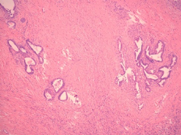 已确诊-左卵巢交界性内膜样囊性腺纤维瘤图3