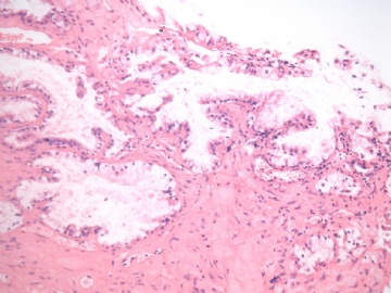 已确诊-左卵巢交界性内膜样囊性腺纤维瘤图4