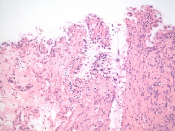 已确诊-左卵巢交界性内膜样囊性腺纤维瘤图5