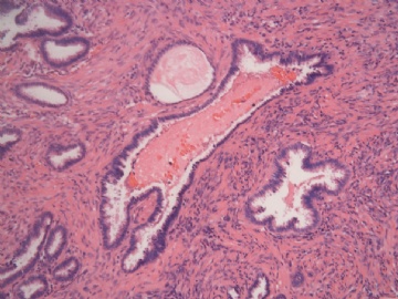 已确诊-左卵巢交界性内膜样囊性腺纤维瘤图6