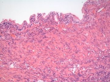 已确诊-左卵巢交界性内膜样囊性腺纤维瘤图7