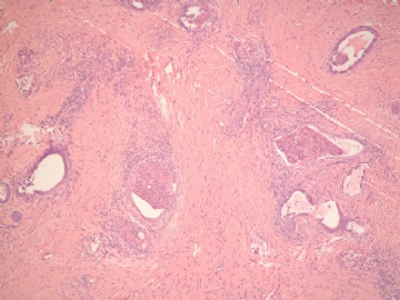 已确诊-左卵巢交界性内膜样囊性腺纤维瘤图8