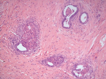 已确诊-左卵巢交界性内膜样囊性腺纤维瘤图9