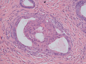 已确诊-左卵巢交界性内膜样囊性腺纤维瘤图10