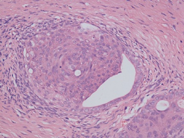 已确诊-左卵巢交界性内膜样囊性腺纤维瘤图11