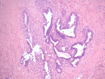 已确诊-左卵巢交界性内膜样囊性腺纤维瘤图12