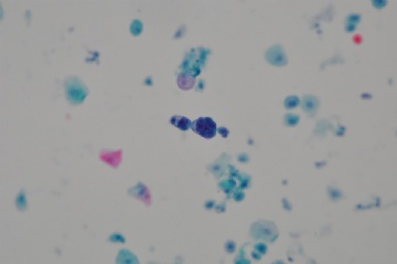 （已公布）山东省细胞病理学会议病例22图1