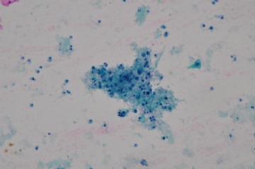 （已公布）山东省细胞病理学会议病例26图2