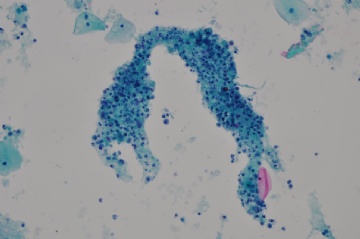 （已公布）山东省细胞病理学会议病例26图4